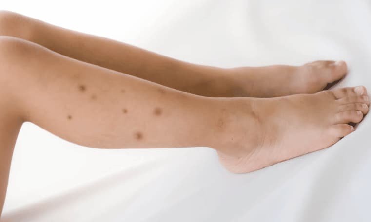 Punture di Cimici gambe